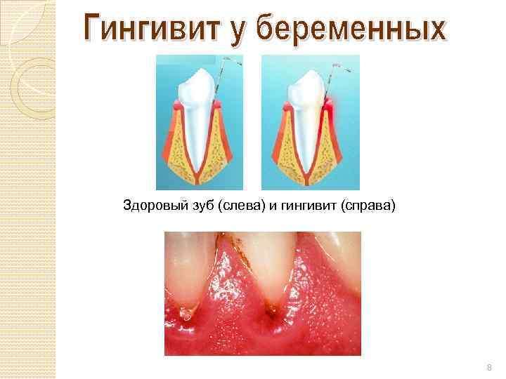Здоровый зуб (слева) и гингивит (справа) 8 