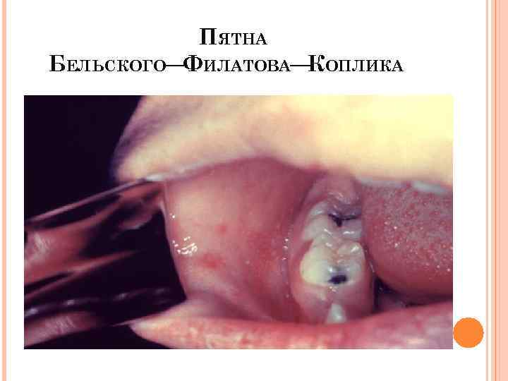 ПЯТНА БЕЛЬСКОГО— ИЛАТОВА— ОПЛИКА Ф К 