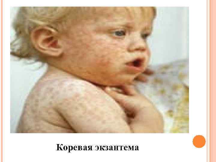 Коревая экзантема 