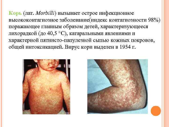 Корь (лат. Morbilli) вызывает острое инфекционное высококонтагиозное заболевание(индекс контагиозности 98%) поражающее главным образом детей,