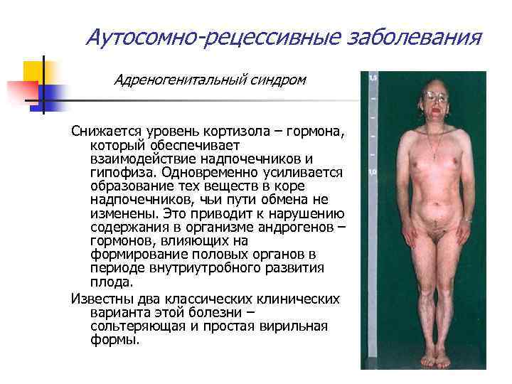 Аутосомно-рецессивные заболевания Адреногенитальный синдром Снижается уровень кортизола – гормона, который обеспечивает взаимодействие надпочечников и