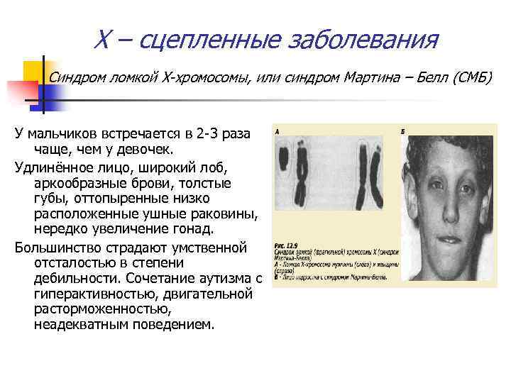 Х – сцепленные заболевания Синдром ломкой Х-хромосомы, или синдром Мартина – Белл (СМБ) У