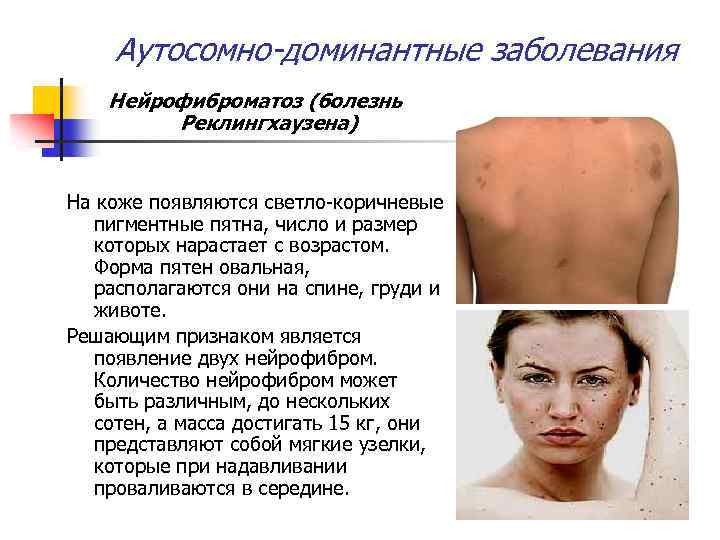 Аутосомно-доминантные заболевания Нейрофиброматоз (болезнь Реклингхаузена) На коже появляются светло-коричневые пигментные пятна, число и размер