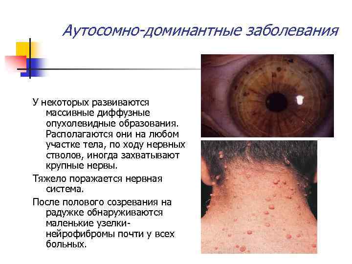 Аутосомно-доминантные заболевания У некоторых развиваются массивные диффузные опухолевидные образования. Располагаются они на любом участке