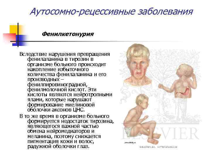 Аутосомно-рецессивные заболевания Фенилкетонурия Вследствие нарушения превращения фенилаланина в тирозин в организме больного происходит накопление