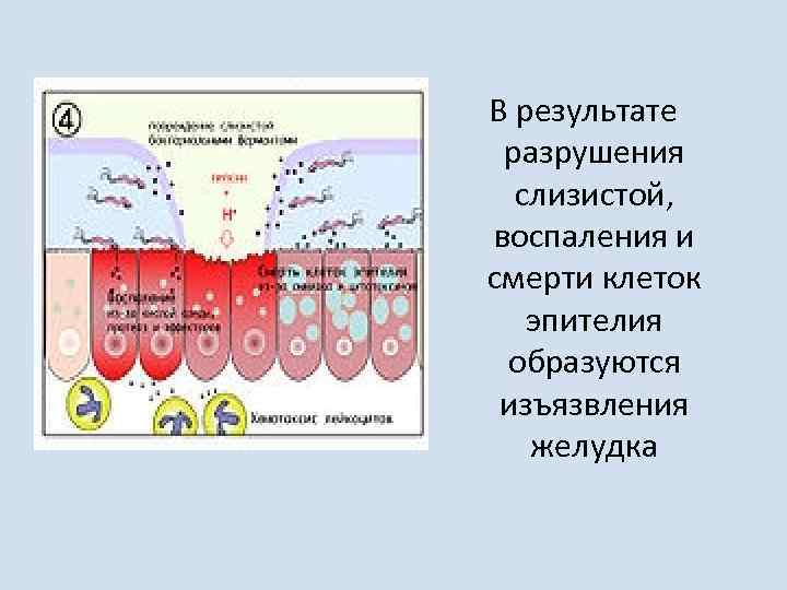В результате разрушения слизистой, воспаления и смерти клеток эпителия образуются изъязвления желудка 