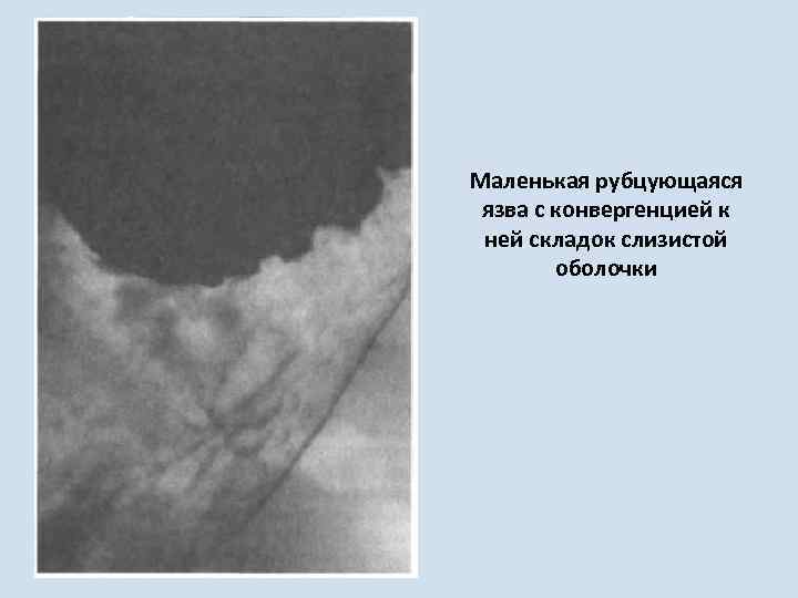 Маленькая рубцующаяся язва с конвергенцией к ней складок слизистой оболочки 