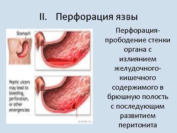 II. Перфорация язвы Перфорацияпрободение стенки органа с излиянием желудочногокишечного содержимого в брюшную полость с