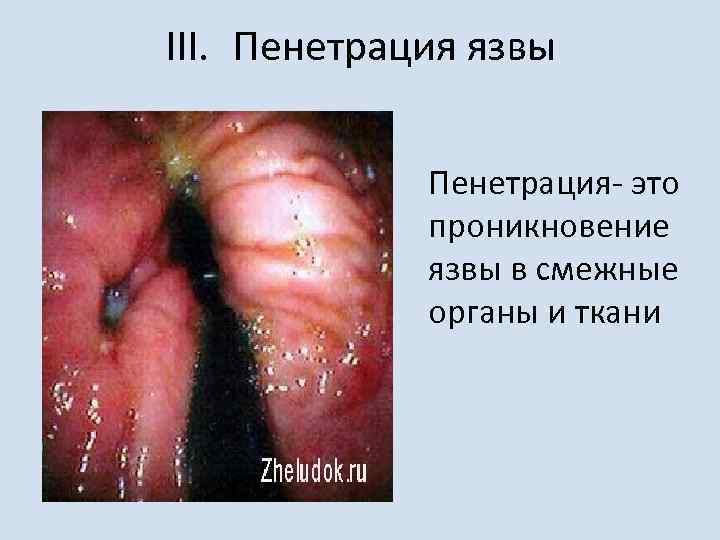 III. Пенетрация язвы Пенетрация- это проникновение язвы в смежные органы и ткани 