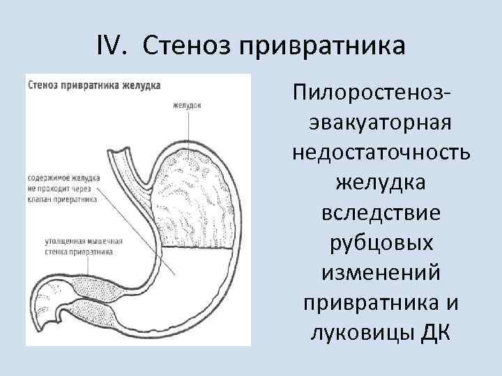 IV. Стеноз привратника Пилоростенозэвакуаторная недостаточность желудка вследствие рубцовых изменений привратника и луковицы ДК 