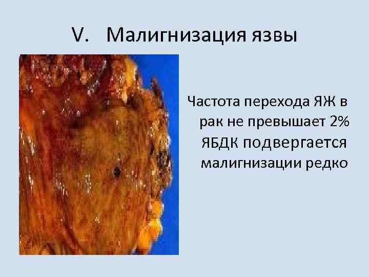 Малигнизация язвы фото