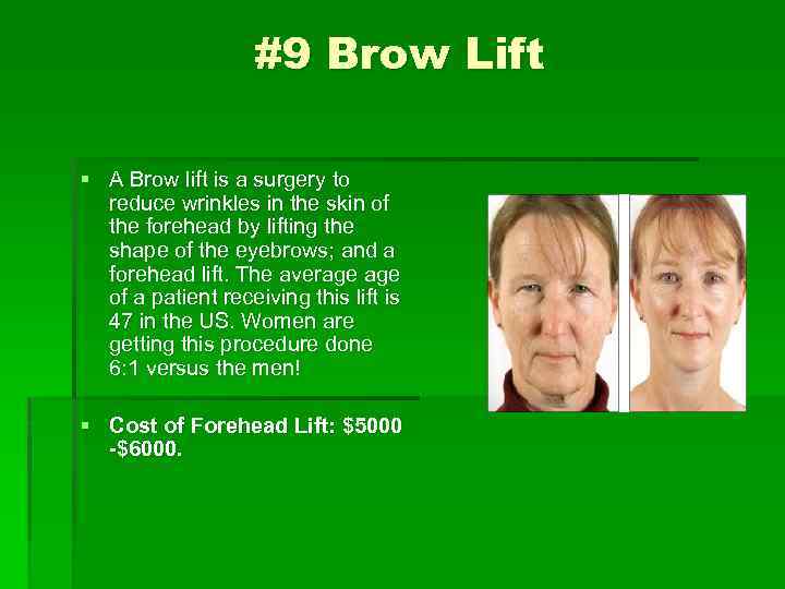 #9 Brow Lift § A Brow lift is a surgery to reduce wrinkles in