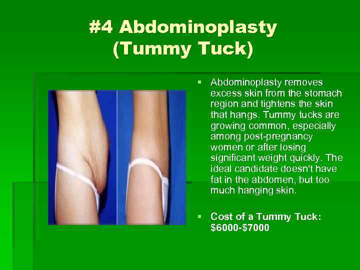 #4 Abdominoplasty (Tummy Tuck) § Abdominoplasty removes excess skin from the stomach region and