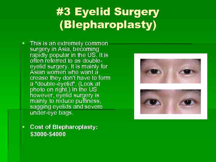 #3 Eyelid Surgery (Blepharoplasty) § This is an extremely common surgery in Asia, becoming