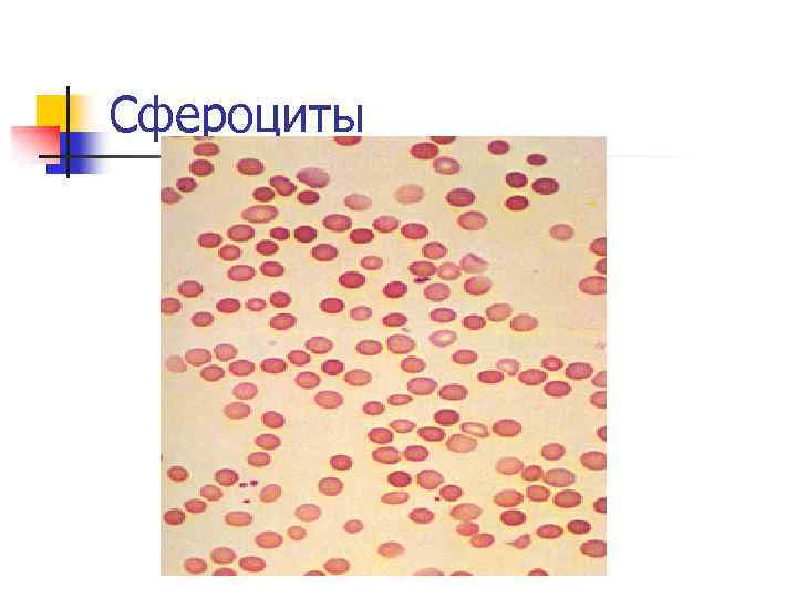 Сфероциты 