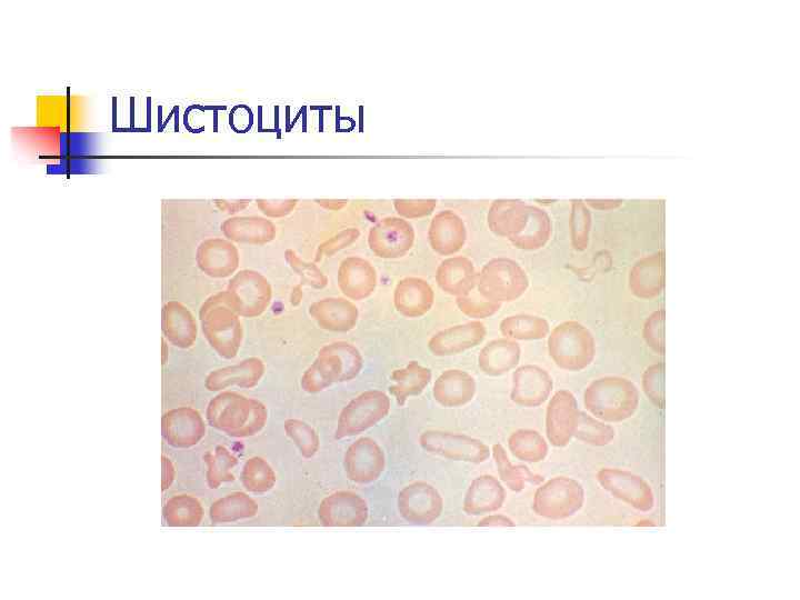 Шистоциты 