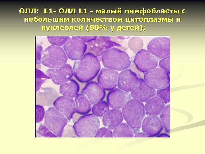 ОЛЛ: L 1 - ОЛЛ L 1 - малый лимфобласты с небольшим количеством цитоплазмы