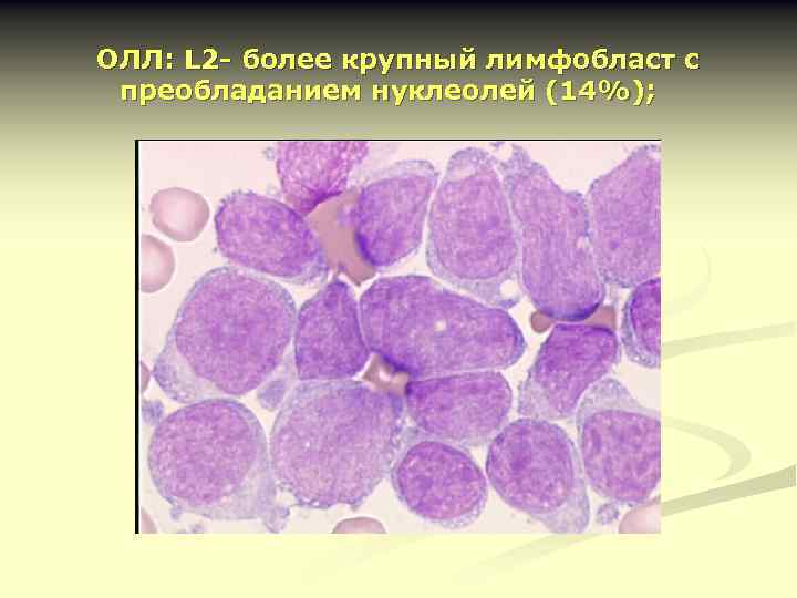 ОЛЛ: L 2 - более крупный лимфобласт с преобладанием нуклеолей (14%); 