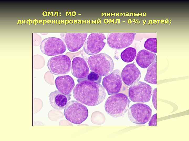 ОМЛ: М 0 минимально дифференцированный ОМЛ - 6% у детей; 