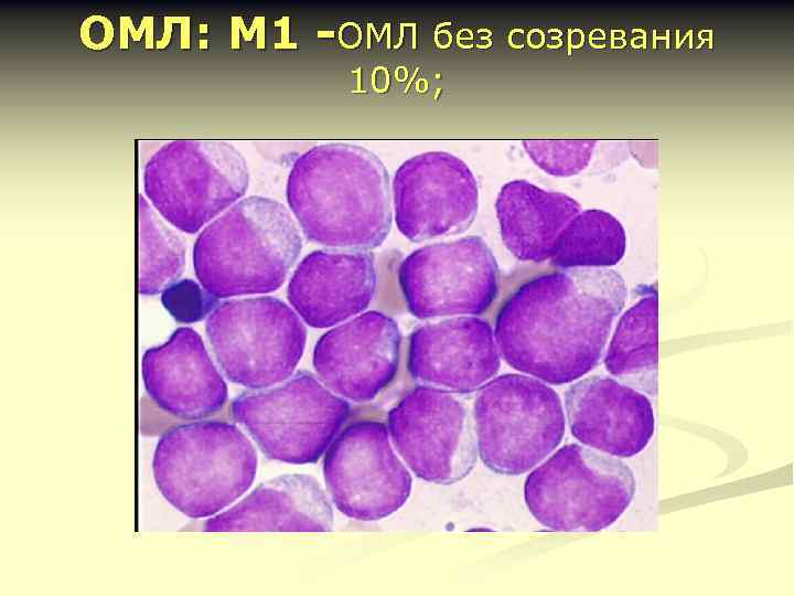 ОМЛ: М 1 -ОМЛ без созревания 10%; 