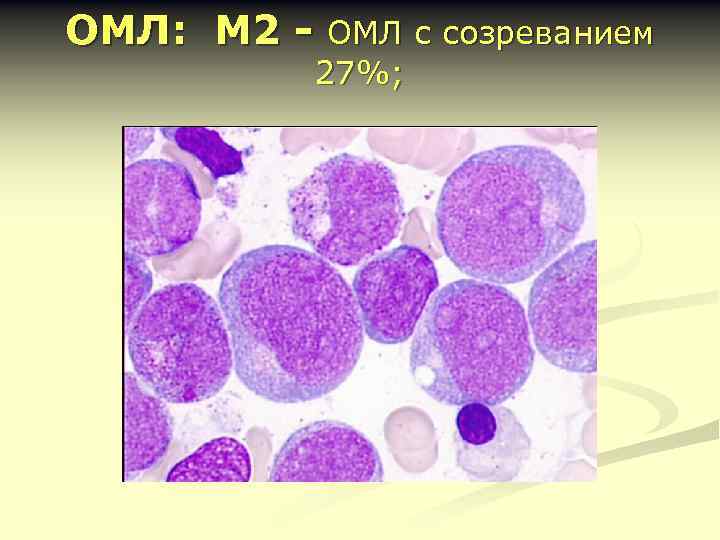 ОМЛ: М 2 - ОМЛ с созреванием 27%; 