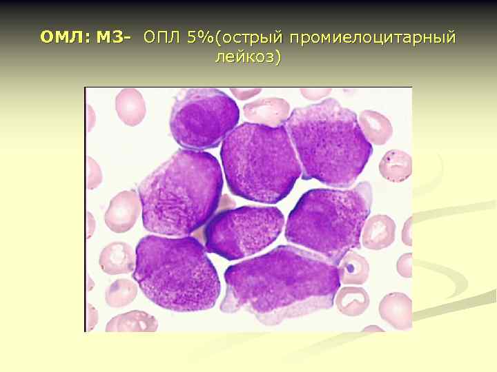 ОМЛ: М 3 - ОПЛ 5%(острый промиелоцитарный лейкоз) 