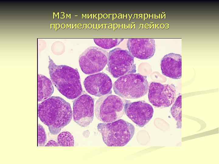 М 3 м - микрогранулярный промиелоцитарный лейкоз 
