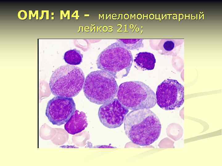 ОМЛ: М 4 - миеломоноцитарный лейкоз 21%; 