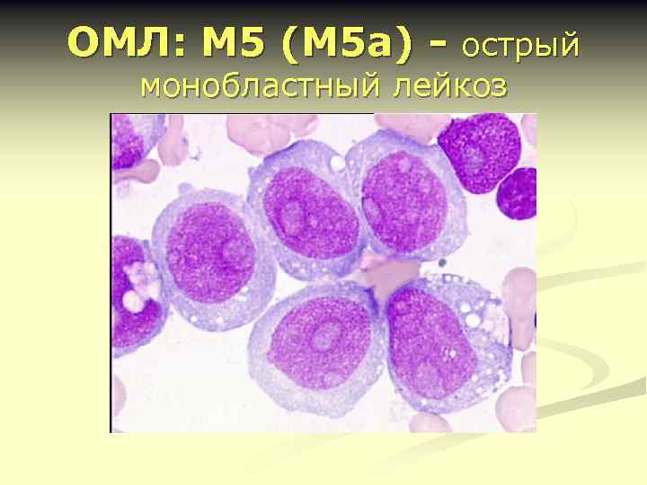 ОМЛ: М 5 (М 5 а) - острый монобластный лейкоз 