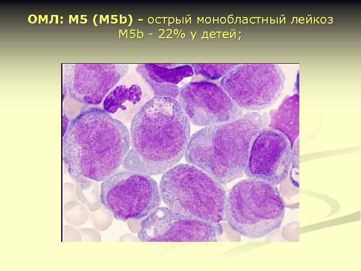 ОМЛ: М 5 (М 5 b) - острый монобластный лейкоз М 5 b -