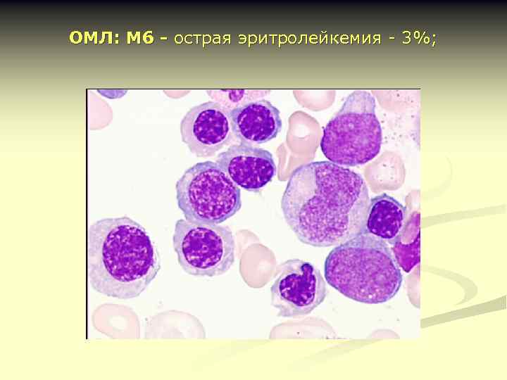 ОМЛ: M 6 - острая эритролейкемия - 3%; 