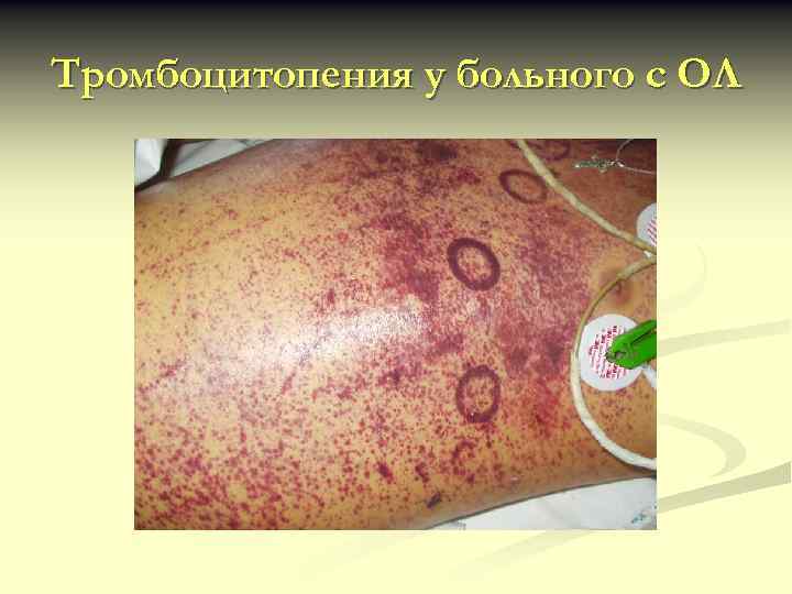 Тромбоцитопения у больного с ОЛ 
