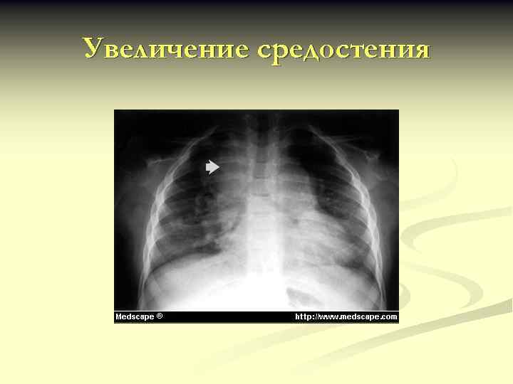 Увеличение средостения 