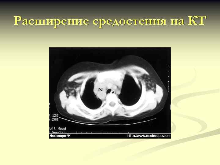 Расширение средостения на КТ 