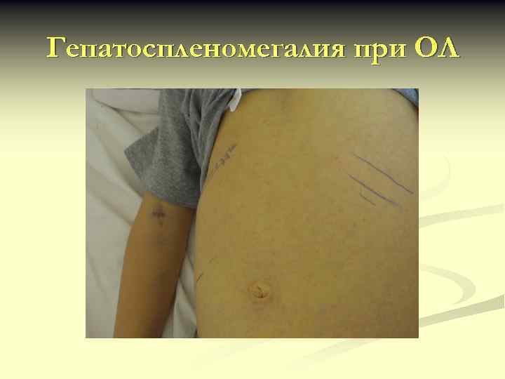 Гепатоспленомегалия при ОЛ 