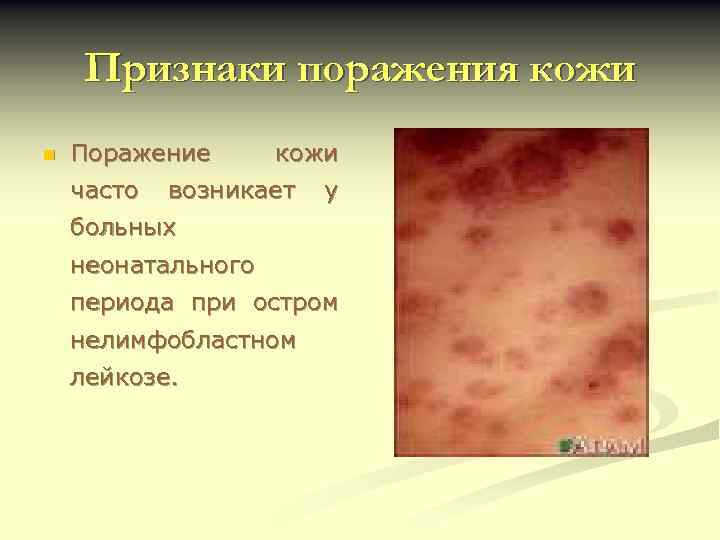 Признаки поражения кожи n Поражение часто кожи возникает у больных неонатального периода при остром