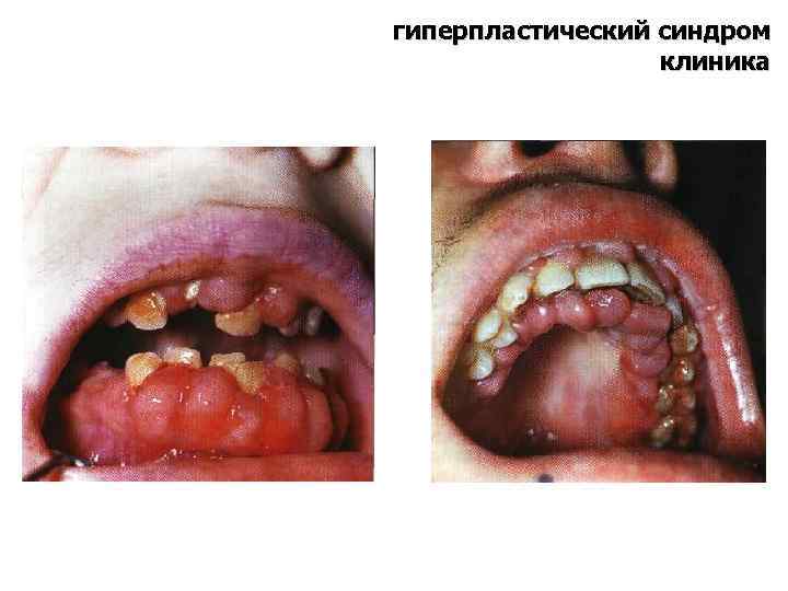 гиперпластический синдром клиника 