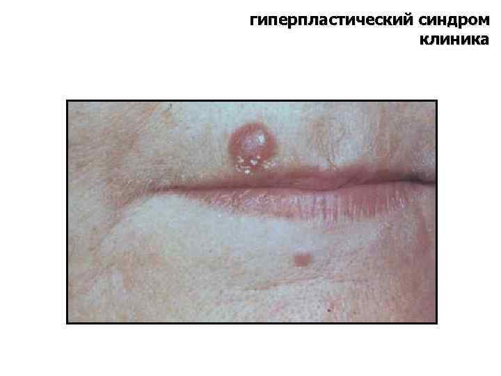 гиперпластический синдром клиника 