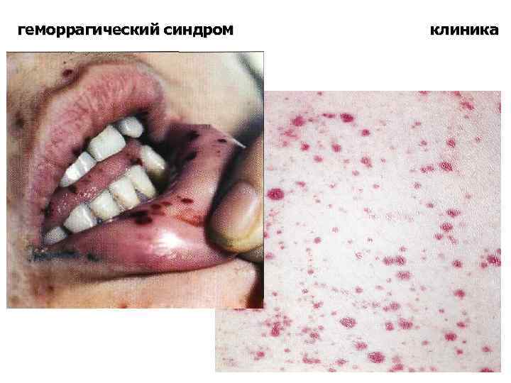 геморрагический синдром клиника 