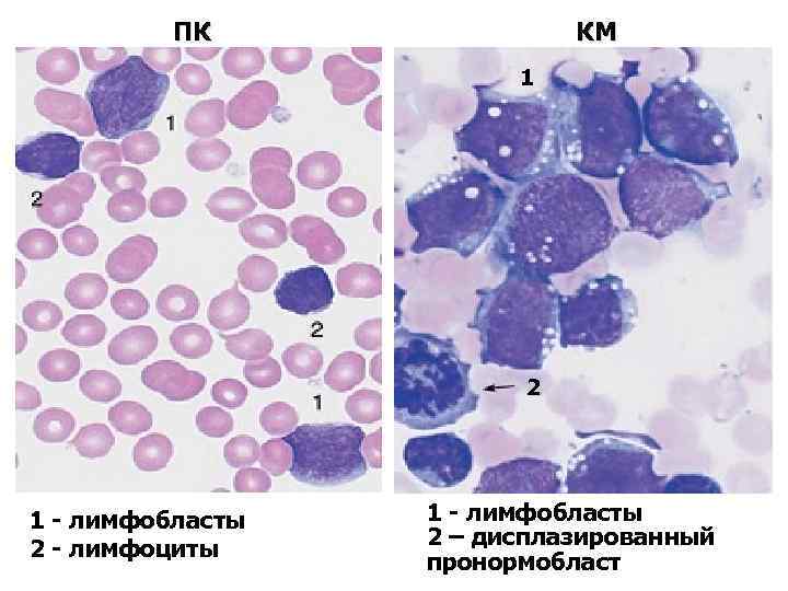 ПК КМ 1 2 1 - лимфобласты 2 - лимфоциты 1 - лимфобласты 2