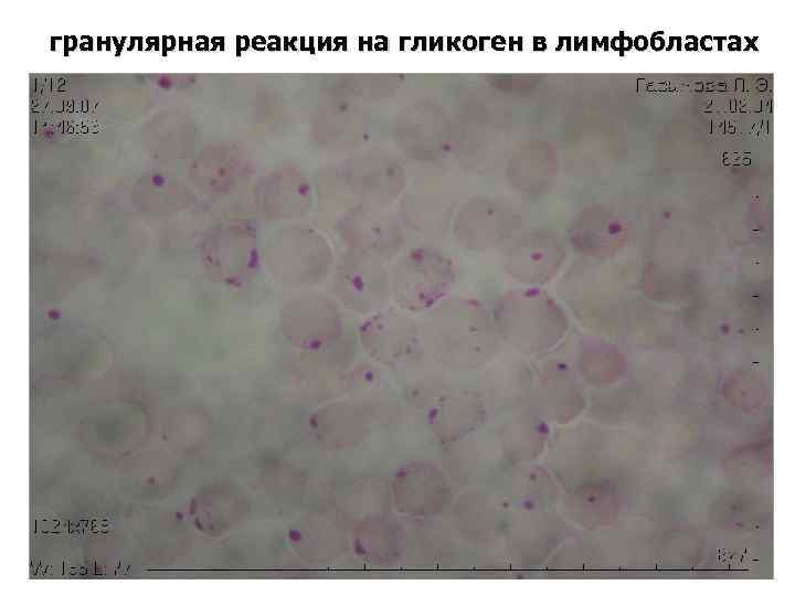 гранулярная реакция на гликоген в лимфобластах 
