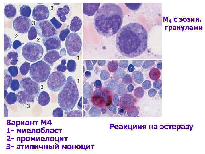 М 4 с эозин. гранулами Вариант М 4 1 - миелобласт 2 - промиелоцит