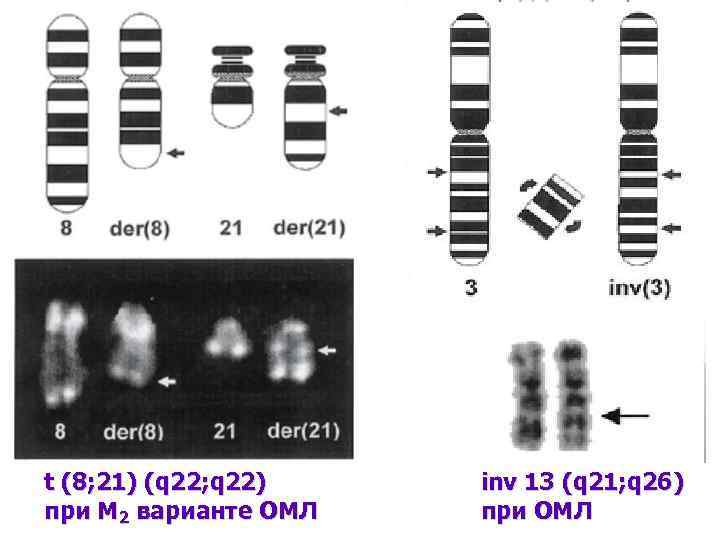 t (8; 21) (q 22; q 22) при М 2 варианте ОМЛ inv 13