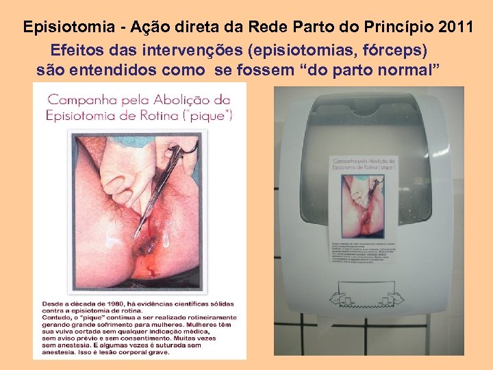 Episiotomia - Ação direta da Rede Parto do Princípio 2011 Efeitos das intervenções (episiotomias,