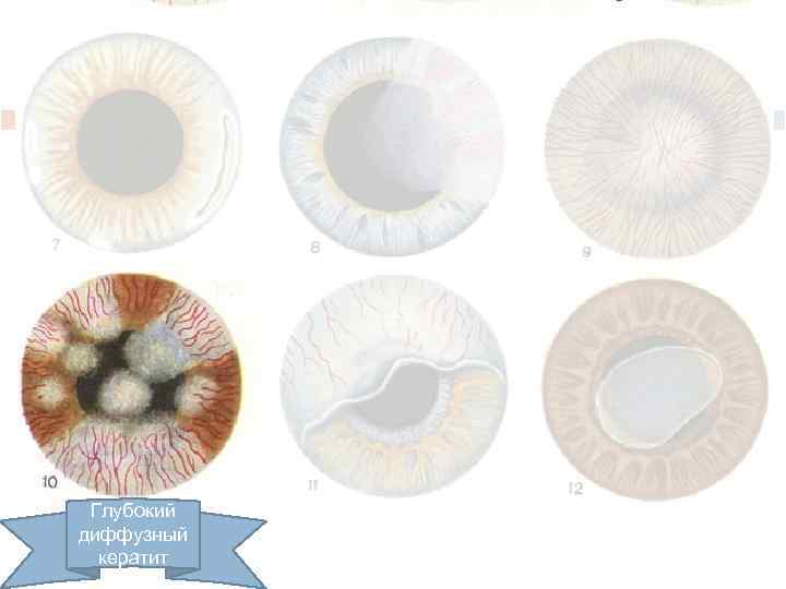 Глубокий диффузный кератит 