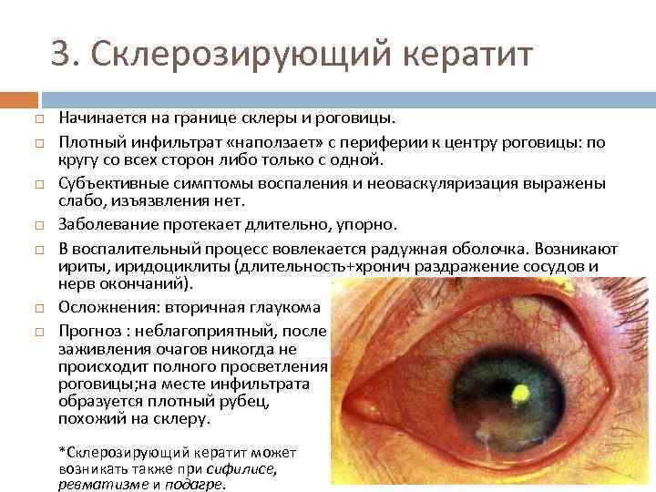 3. Склерозирующий кератит Начинается на границе склеры и роговицы. Плотный инфильтрат «наползает» с периферии