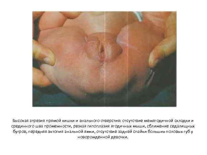 Высокая атрезия прямой кишки и анального отверстия: отсутствие межягодичной складки и срединного шва промежности,