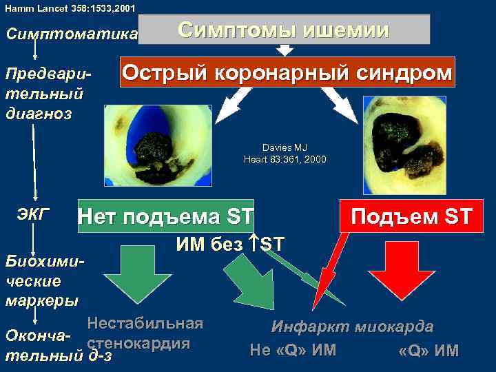 Hamm Lancet 358: 1533, 2001 Симптоматика Предварительный диагноз Симптомы ишемии Острый коронарный синдром Davies