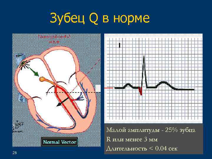 Изменение зубца q. Зубец q на ЭКГ В норме. Нормальная амплитуда зубца q составляет. Патологический зубец q. Амплитуда зубца q в норме.