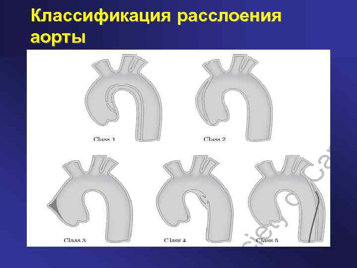 Классификация расслоения аорты 